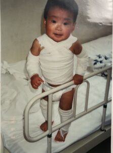 1歳半アトピー悪化で入院し全身包帯の画像